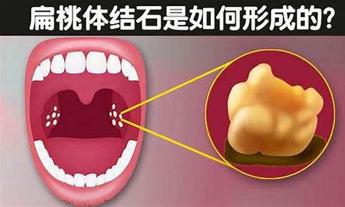 啥子生肖没有扁桃体_没有扁桃体属于什么缺陷